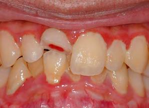 98 Figure 3: Enamel dentine pulp fracture: Case B.