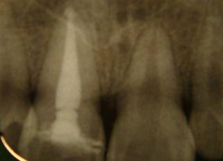 through damage to periodontal ligament, alveolar bone and gingival attachment as well as
