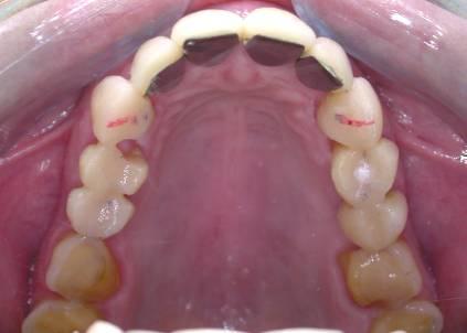 premolars Occlusion