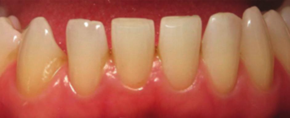 Treatment time was 45 minutes to restore teeth 7, 8, and 9.