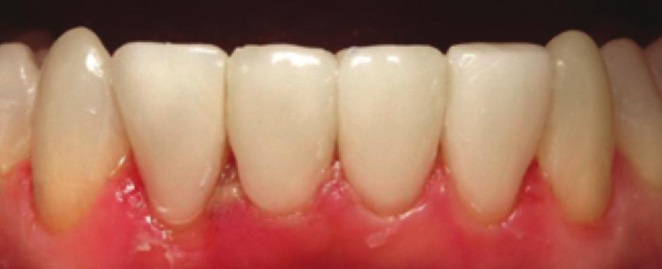 5 hours for teeth 22-27 using Vit-l-escence PN composite, and required no
