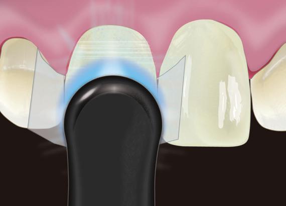 Apply Peak Universal Bond or preferred adhesive to tooth surface.