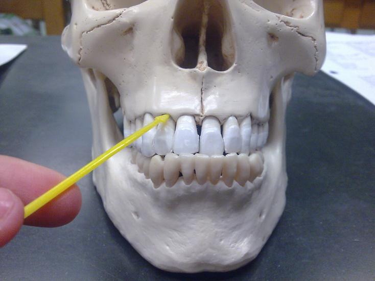 Skull Facial Bones-Maxillae Maxillae (2): - Form the upper jaw. - Two s fuse before birth. - Largest facial.