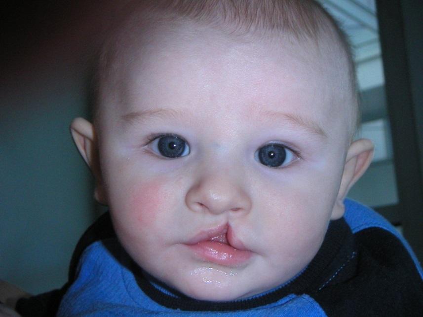 *Slide 11-Rotate Cleft palate: birth defect when maxillae fail to meet along the midline of