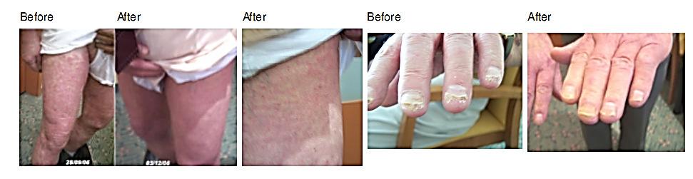 II. PSORIASIS Clinical test for ALOCADO 75 years old PASI index at start 9. for the past 5 years no improvement whatever medicine taken.