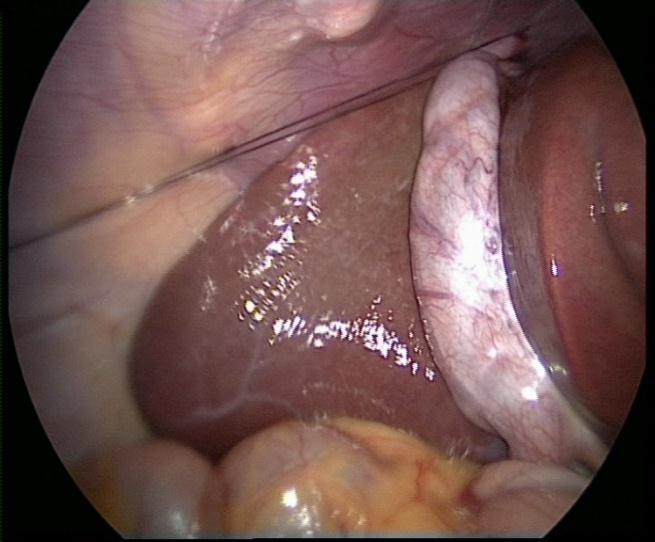 Most of the patient presented with pain in abdomen mainly in right hypochondrium followed by pain in epigastrium. Some patient presented with symptom like dyspepsia, bloating, and heartburn.