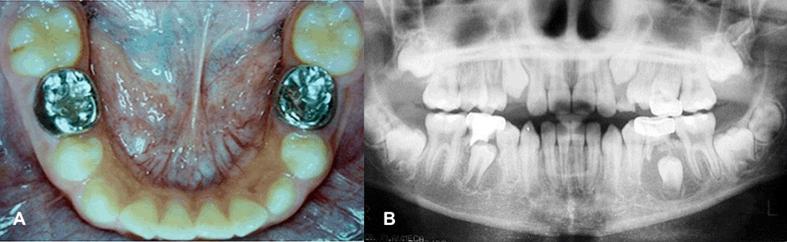 the mandibular third molar, the maxillary canine and the mandibular premolars come second [9].