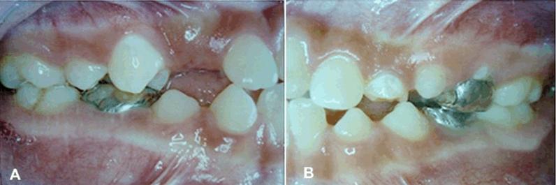 They usually cause considerable increase in volume through the cortical bone expansion and delay in tooth eruption [11, 12].