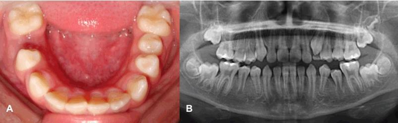 dentigerous cysts, defective mandibular condyle and retained teeth [7].