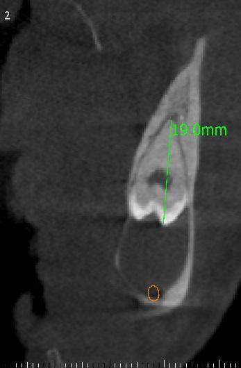 The CBCT findings were suggestive of a dentigerous cyst in relation to 38 All the parameters were within normal limits on routine hematological