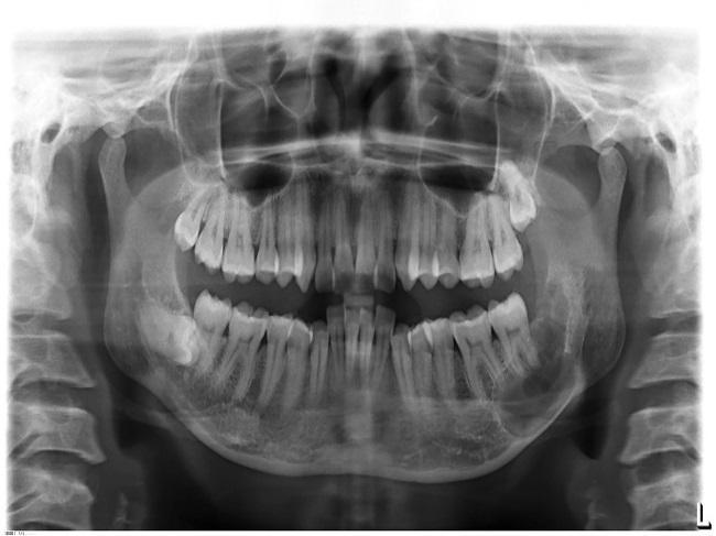 The development of dentigerous cyst is due to fluid accumulation between the epithelium and the crown of an unerupted tooth.