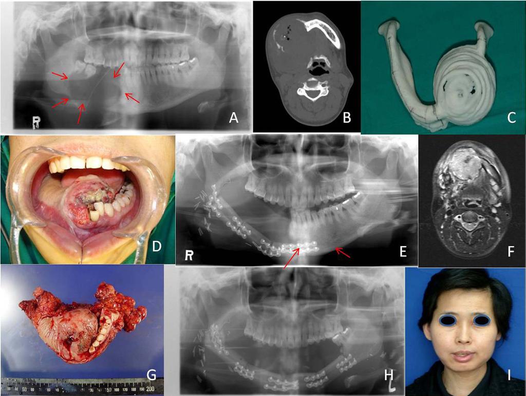 Case Report Clinical features and hospital course A 47-year-old Korean woman visited our department because of a slow-growing, painful and swelling mass in her right mandible six years ago (Sep 10,