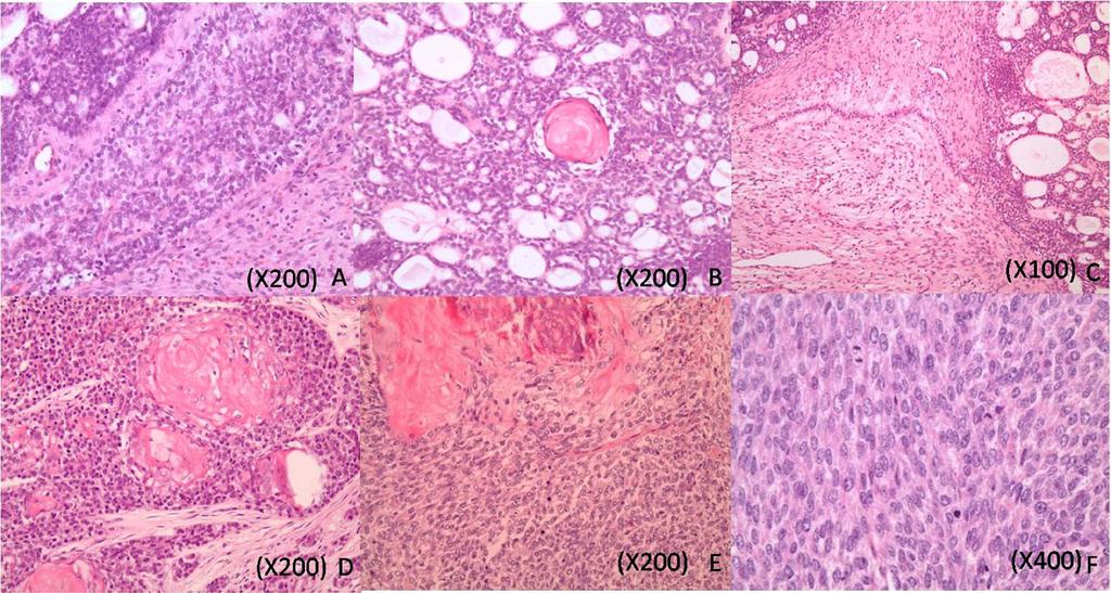 Immunohistochemical finding The biopsy and surgical specimens of OGCT and its malignant form went through microscopic examination with a panel of immunohistochemical stain including; cytokeratin5