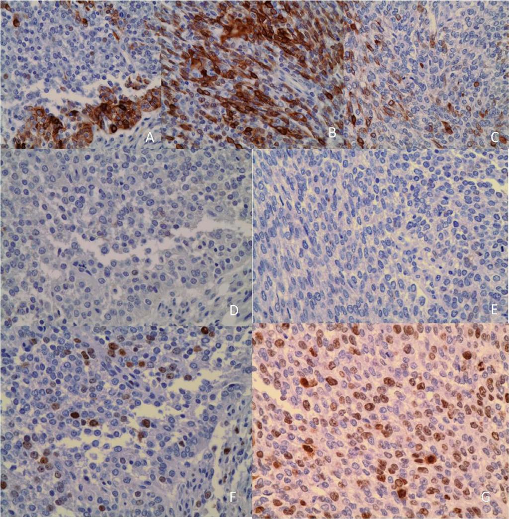 Fig. 3. Immunohistochemical studies using CK5 & 14, CK18, and KI-67. Upper three photomicrograms are. CK5&14 stain, OGCT(A,B) and OGCC(C). Middle photomicrograms are CK18 stains, OGCT(D) and OGCC(E).