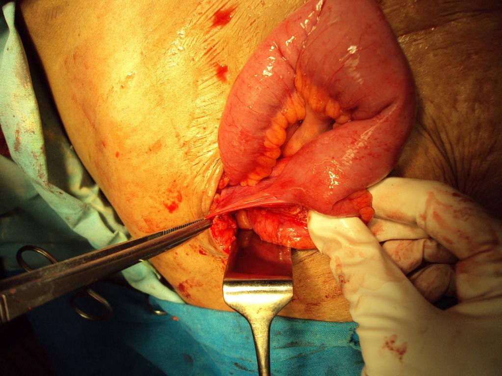 The age of these patients ranged from 10years to 48years, mean age was 29 years. Two patients [0.2%] had early postoperative small intestinal obstruction within 6 months of appendectomy, 13 [1.