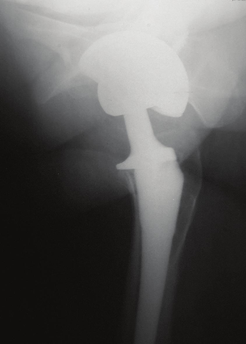 Direct lateral radiograph confirmed femoral head subluxation (Figure 1(b)) and excessive acetabular component anteversion.