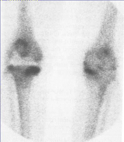 years after surgery porous coated: stimulates bone ingrowth => activity > 3 yrs: Simultanuous uptake at smooth surface: press-fit, tip and lesser