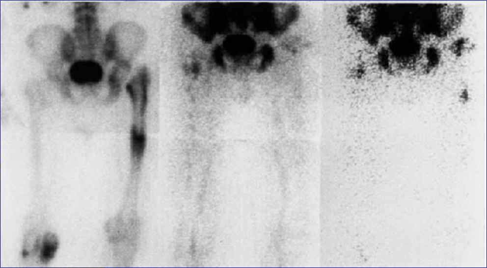 Bone/leukocyte imaging Bone/leukocyte scan: why not so accurate?