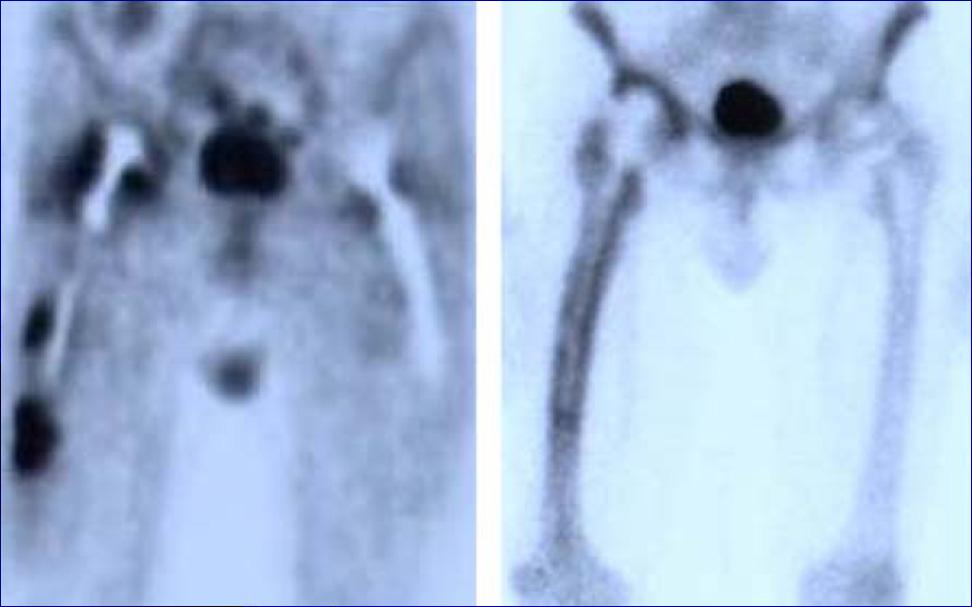 FDG PET VS BONE SCINTIGRAPH PATTERN V FDG PET TPBS FDG PET(-CT) IMAGING IN INFECTED PROSTHESIS No final conclusion in literature to diagnose septic from aseptic loosening in THR Pooled average