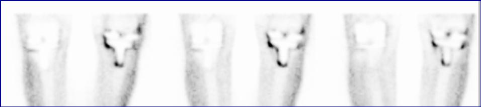 FDG PET for prosthetic infections R L R L R L false positive result: aseptic loosening of left total knee prosthesis on FDG PET (surgically proven); normal prosthesis at right