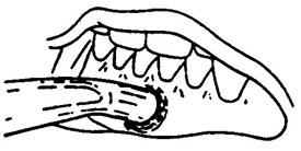 The space created between the root and denture base will allow the full resilient function of the pivoting metal denture cap over the LOCATOR male. 3.