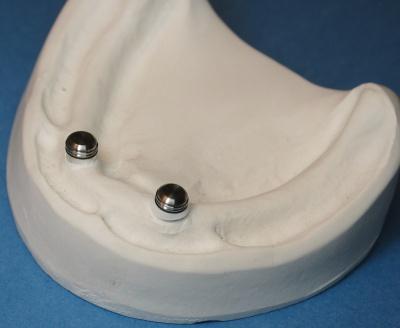 The space created between the root and denture base will allow the full resilient function of the pivoting metal denture cap over the LOCATOR male. 9.