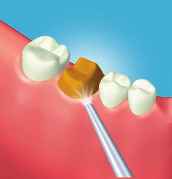 + For cementation of zircornia or alumina restorations, step 2 and 3 are not required.