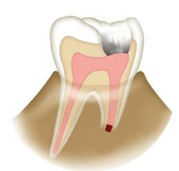 tear-off line APEXIFICATION 1. Isolate the operative area with a rubber dam and prepare the root canal system for treatment. 2.