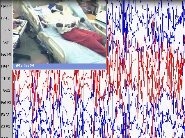 Seizures of Unknown Onset Hypothetical case: You hear a noise and enter the video-eeg room to find the patient in bed, grunting, eyes rolled up, all limbs stiff, then rhythmically