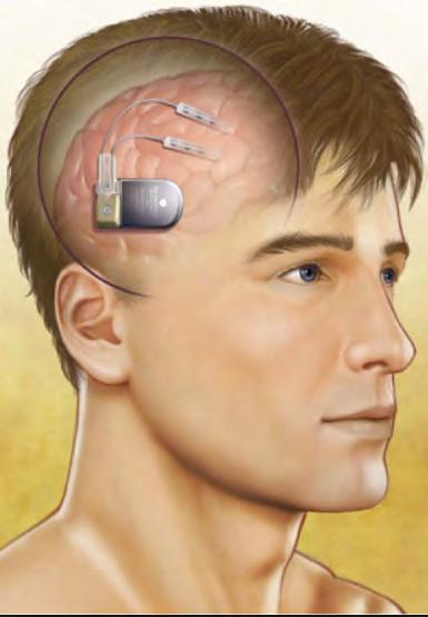 Neurostimulator is placed under the scalp, in the skull, leads are positioned at the seizure focus and