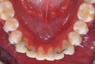 Anterior Torque Correction with Bracketless Fixed Orthodontics TABLE 1 MILLER S CLASSIFICATION OF RECESSION-TYPE DEFECTS 4 Class I Marginal tissue recession that does not extend to the mucogingival