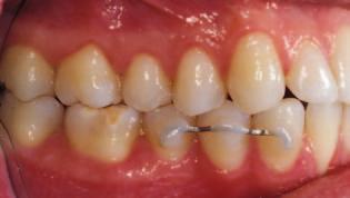 Class III Marginal tissue recession that extends to or beyond the mucogingival junction, with periodontal attachment loss in the interdental area or malpositioning of teeth.