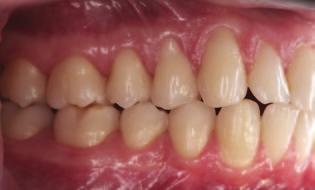 gingival recession. inflammation.