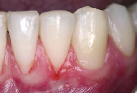 After a new retainer wire was bonded, the patient was referred for periodontal