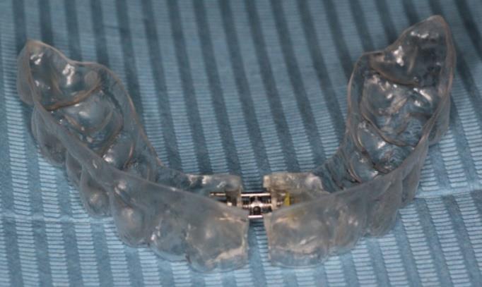 The heated foil is then applied over the dental set-up and the Isofolan foil (that acts like a separating thin layer between the teeth and the appliance).