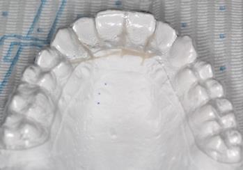 Therefore, the first aligner must include an expansion screw (Clear Aligner screws). After obtaining the required space, other dental corrections can be implemented.