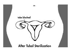postpartum, post-abortion or interval Ambulatory procedure Highly