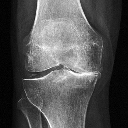 Osteoarthritis Prevention is better than cure?