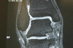 Failed microfracture