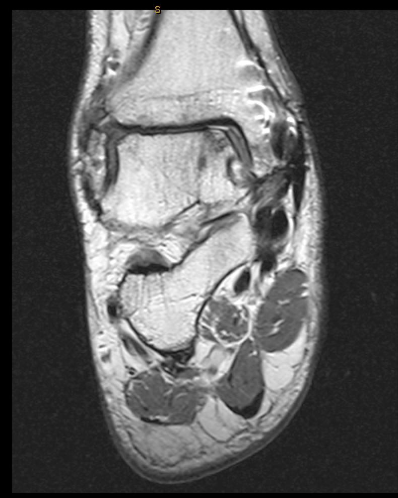 Case report Now 61yrs increasing pain MRI deterioration