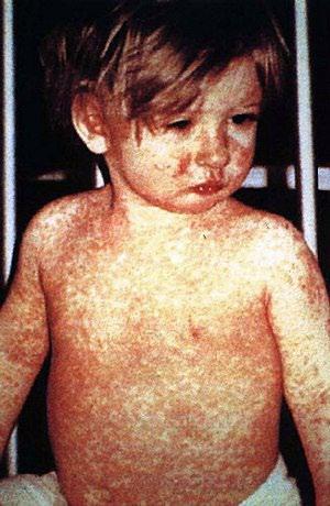 .. Chickenpox and measles are caused by viruses, and both are very contagious. This means they can spread very easily from one person to another.