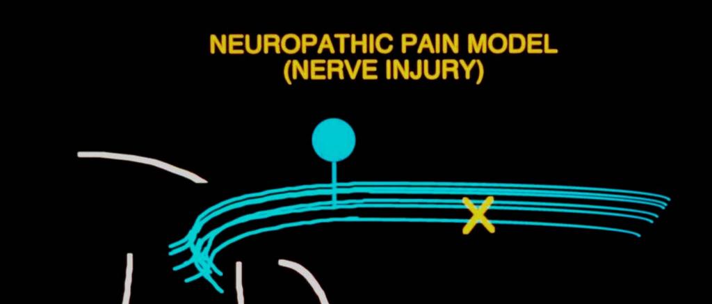 NEUROPATHIC PAIN