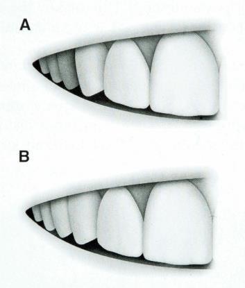 Visibility of upper teeth on smiling Even if crown margins were not visible on smiling, a survey of 383 patients has shown that 15% of men