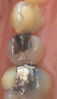 Treatment combinations often needed for improving dental aesthetics Direct-placement