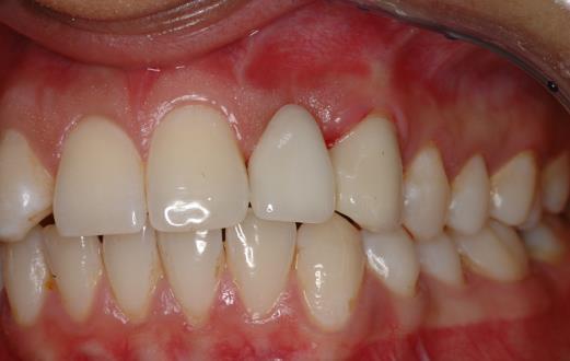 by the choice of final restoration: Partial denture Resin-retained bridgework Implant