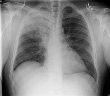 TUBERCULOSIS FIGURE 2. In case 2, chest radiography showed a dense infiltrate in the right upper lobe (arrow), with air bronchograms and possible right-hilar fullness.