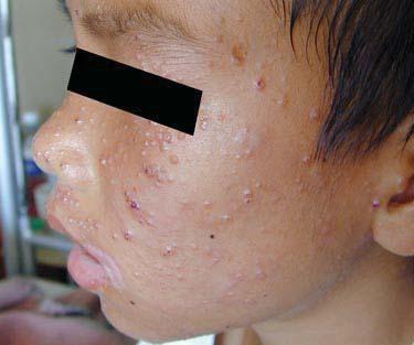Patient 6: HIV-infected child with