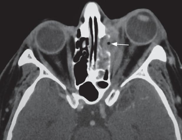 Patient 8: Diabetic patient with sinusitis http://radiographics.rsna.