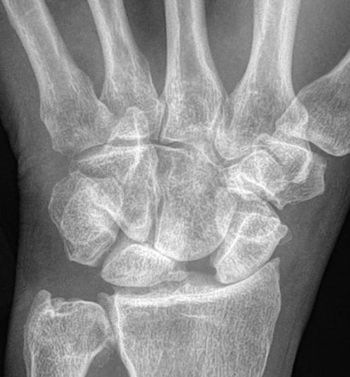 Carpal Instability Dissociative (CID) Scapholunate Advanced Collapse (SLAC wrist) * * Coronal T1-weighted image depicting a stage II SLAC wrist.