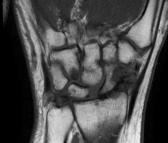 Also, there is a proximal zone scapholunate ligament tear with resulting scapholunate interval widening (asterisk). No significant degeneration of the capitolunate joint.